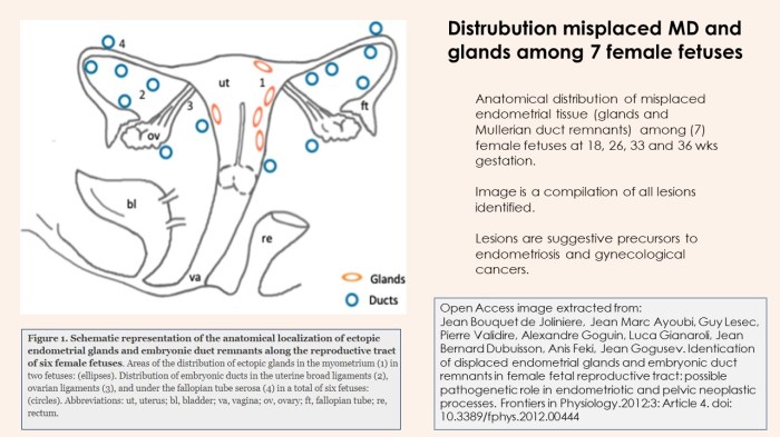 FemaleFetusesmisplacedEndometrialandMDs