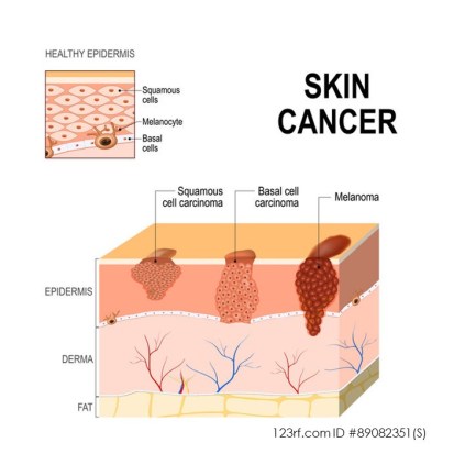 FormsofSkinCancer