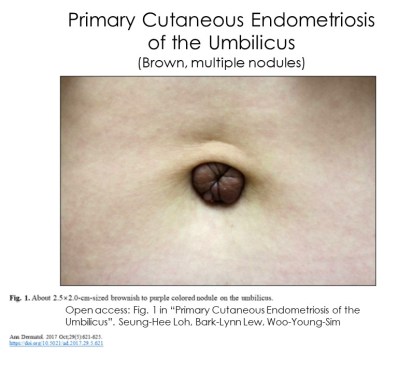 Photo1PrimaryUmbilicusEndo