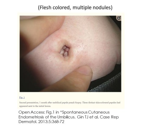 Photo2PrimaryUmbilicusEndo