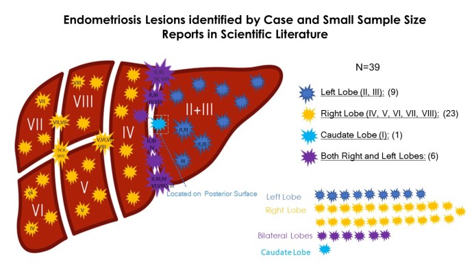 FinalLiverLesions By Lobe and SegmentN38