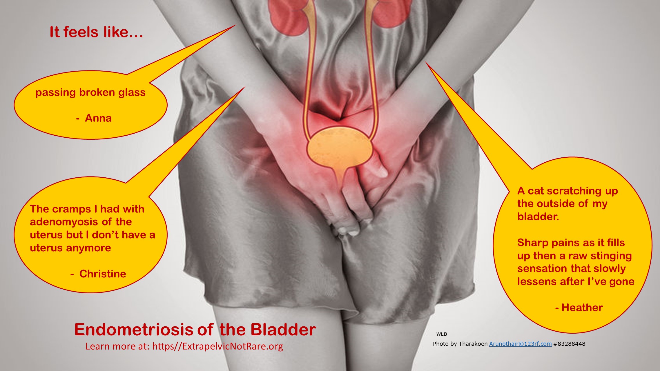Bladder 1 Endo Quotes 1 Final It Feels Like